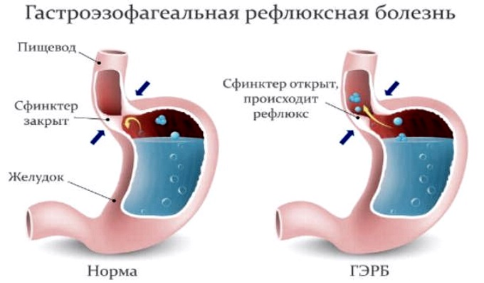 Как вылечить желудочный кашель